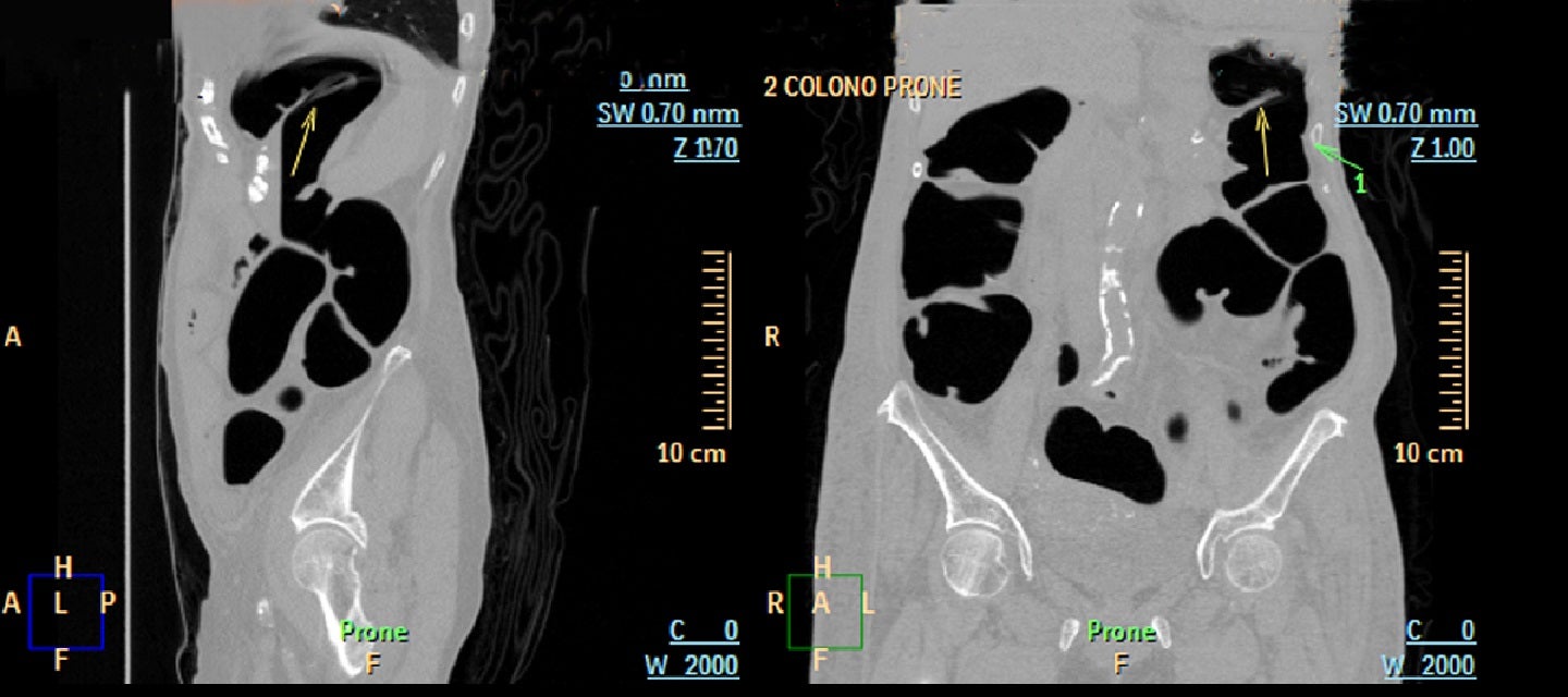 Ct Colonography I Med Radiology Network